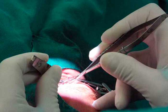 Elogian introducción en Cuba de tecnología para cirugía ocular