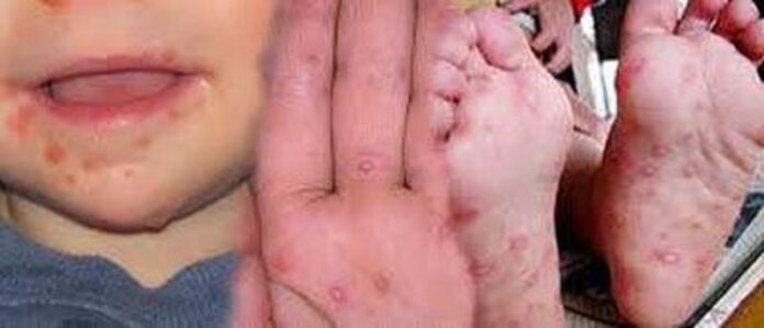 Virus boca-manos-pies, claves para su prevención